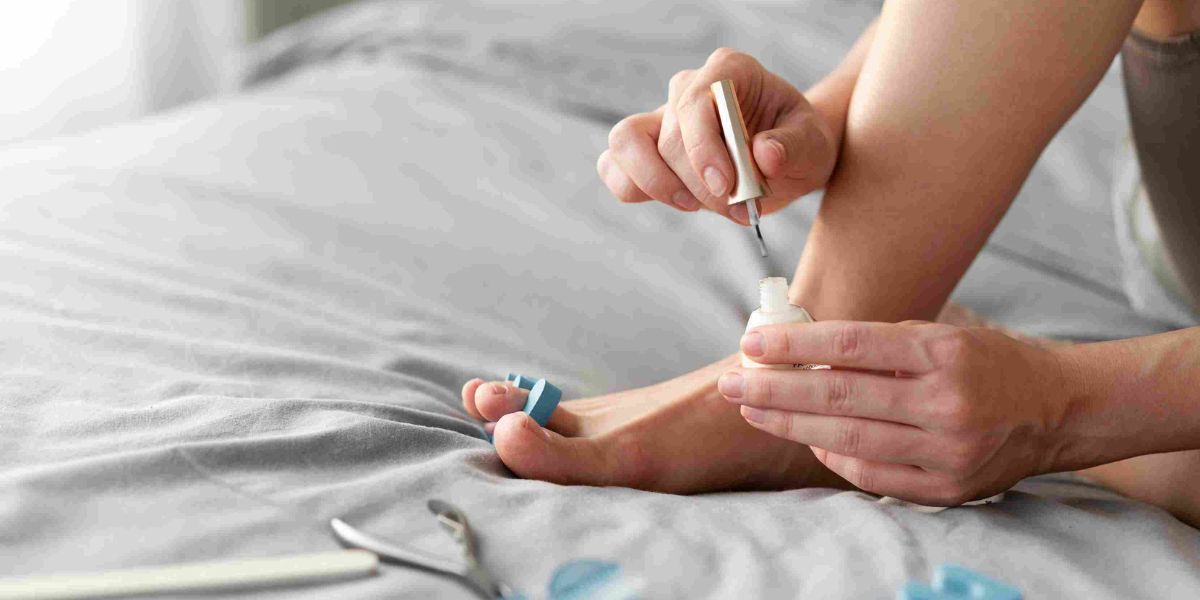 peroxide kills nail fungus