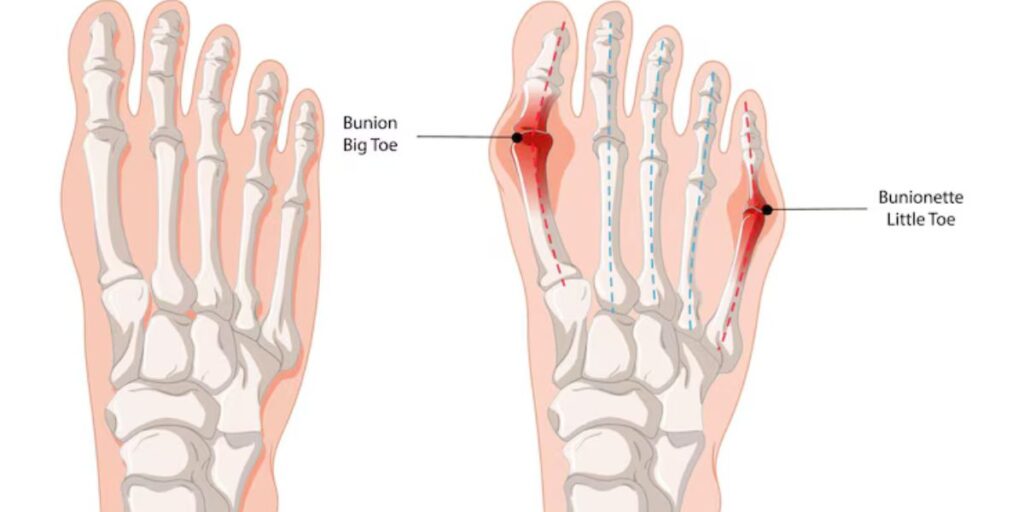 gout vs bunion