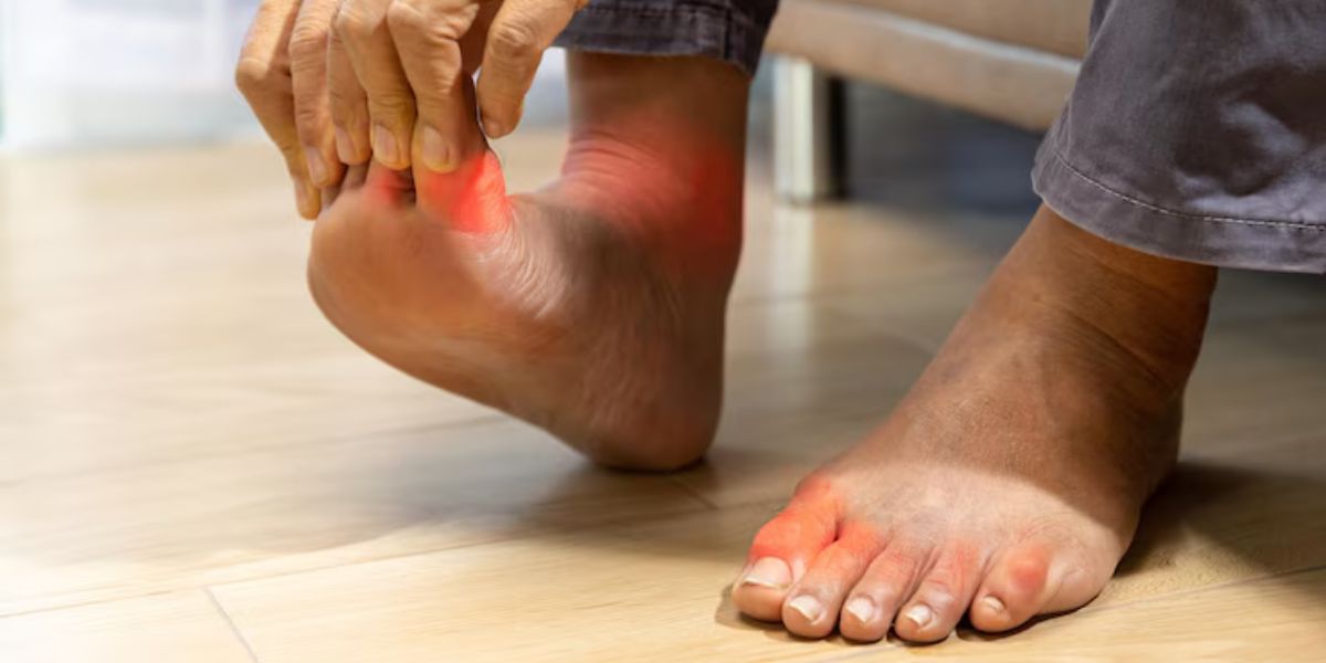 gout vs bunion