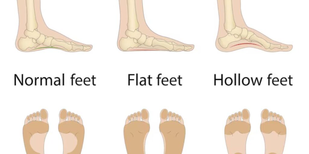 causes of pigeon toes