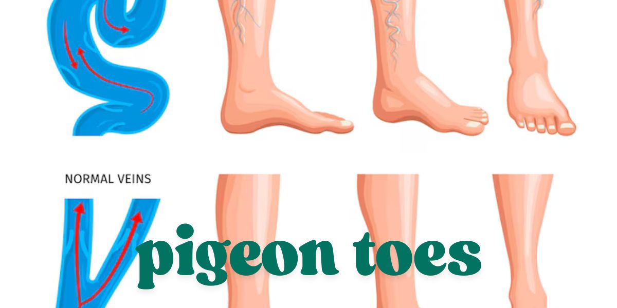 causes of pigeon toes