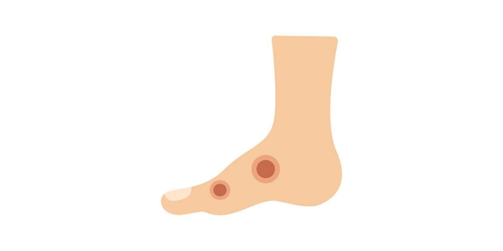 diabetic foot ulcer treatment