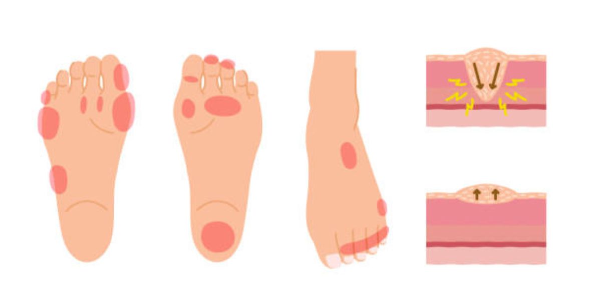 diabetic foot ulcer treatment