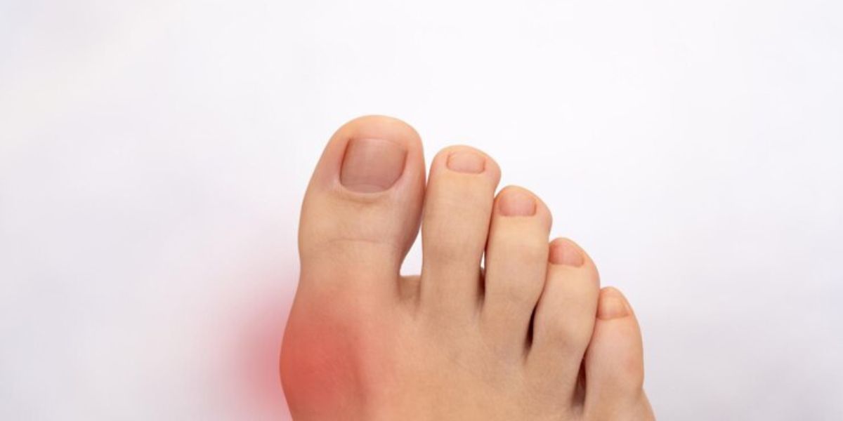 gout in foot