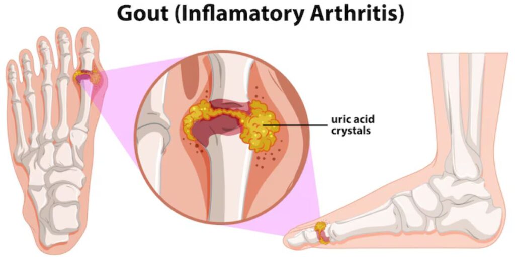 gout in foot