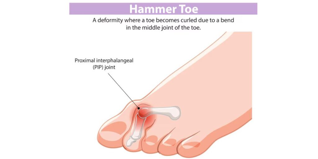 hammertoe surgery