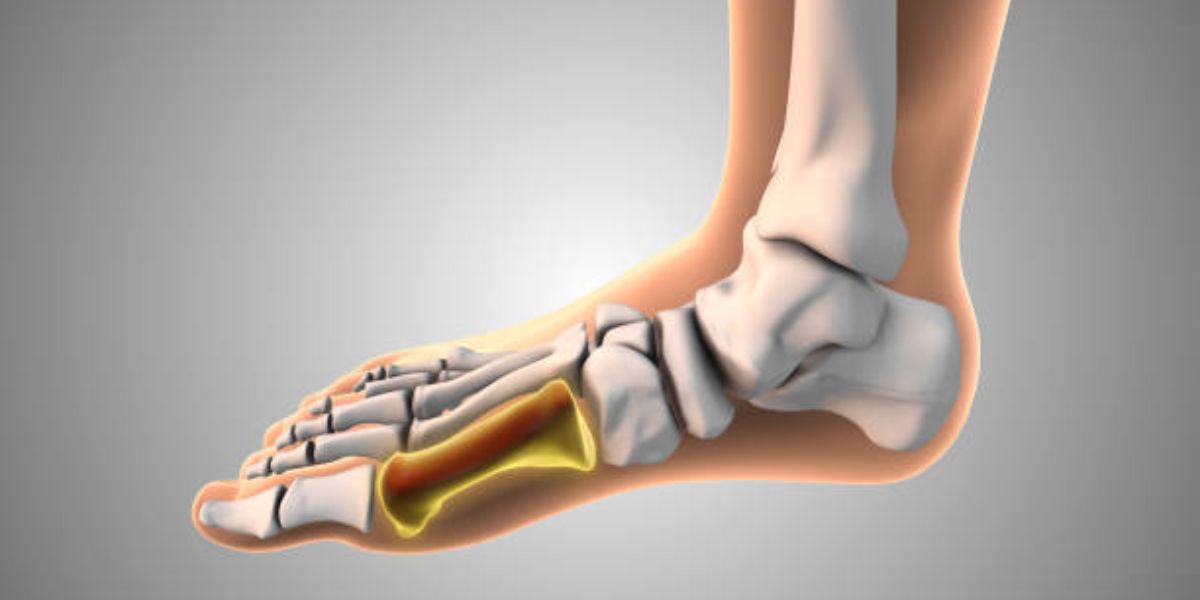 mtp joint fusion surgery
