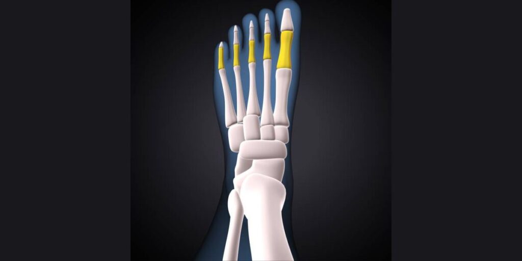 mtp joint fusion surgery 