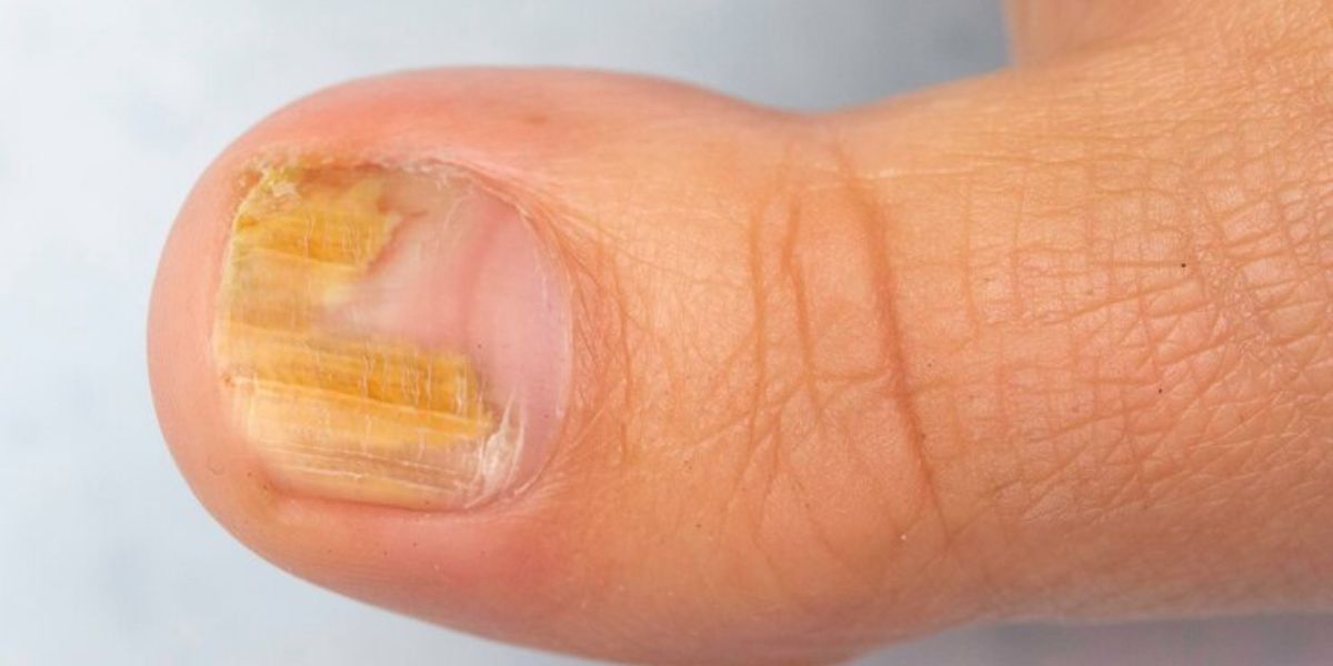 nail polish cause fungus