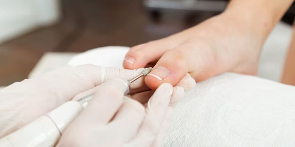 ingrown toenail heal itself