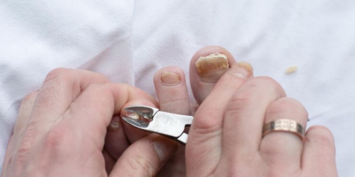 ingrown toenail heal itself