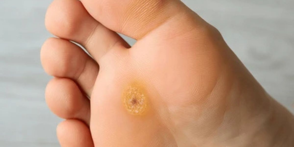 plantar warts contagious