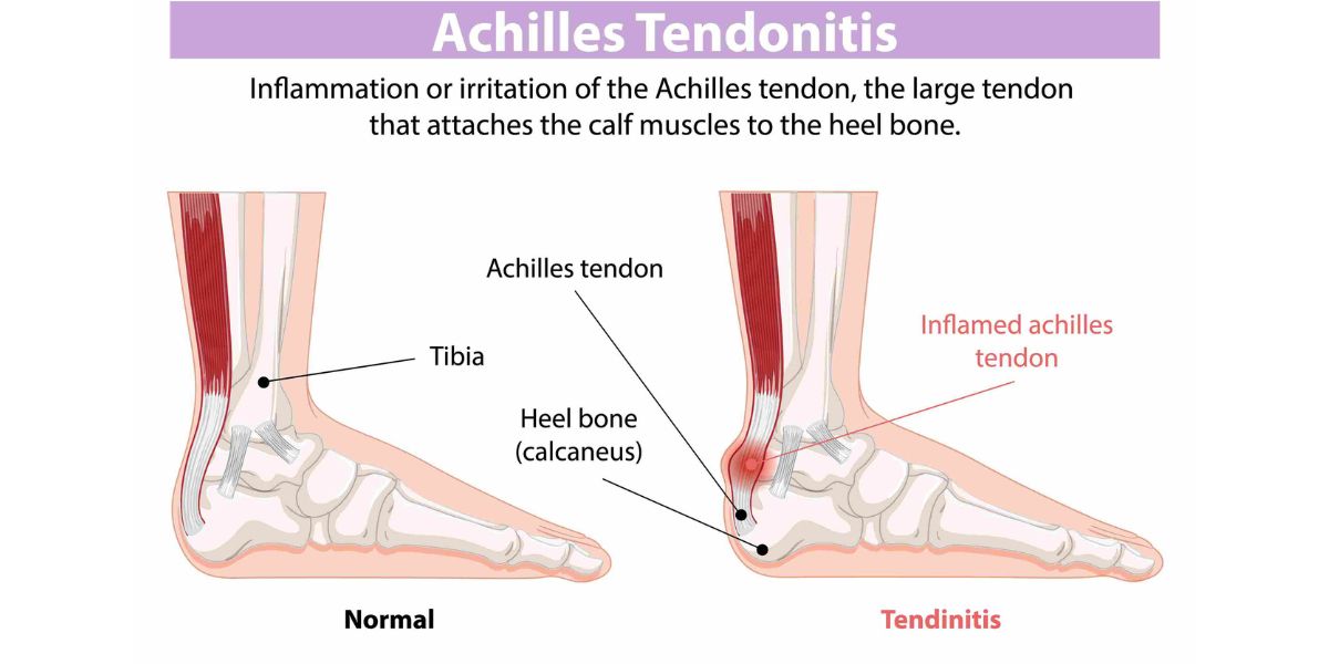achilles tendinitis calcification