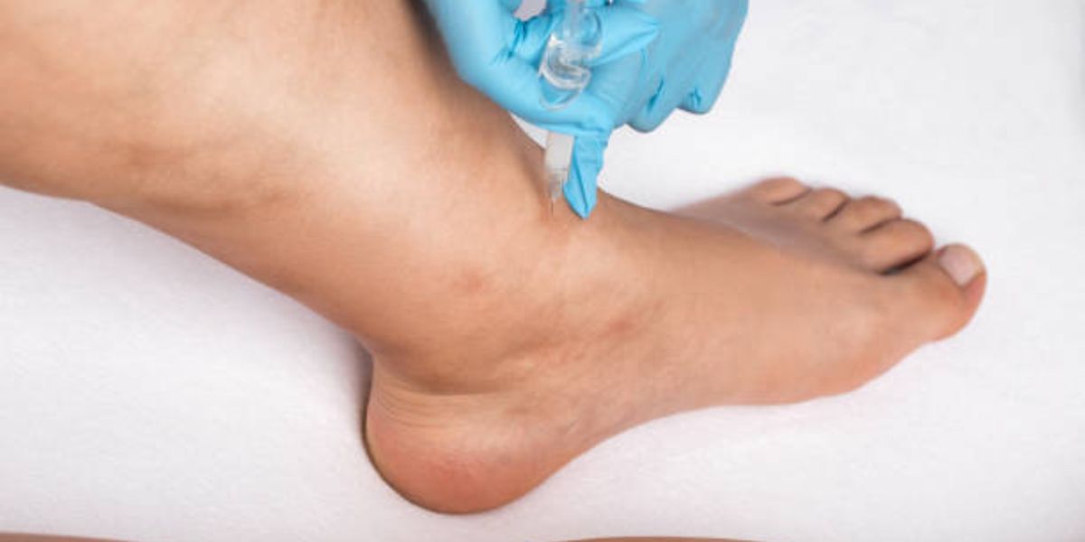 foot surgery for flatfeet
