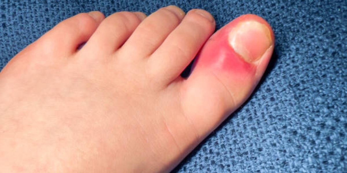 fungal nail infection in children