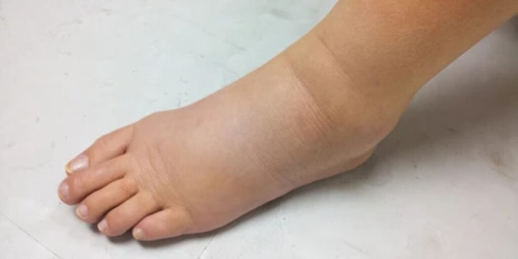 lymphedema in feet