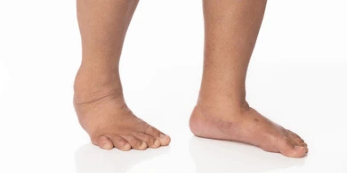 lymphedema in feet