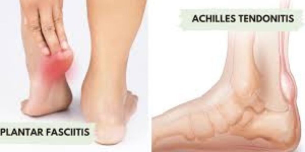 Plantar Fasciitis vs Achilles Tendinitis
