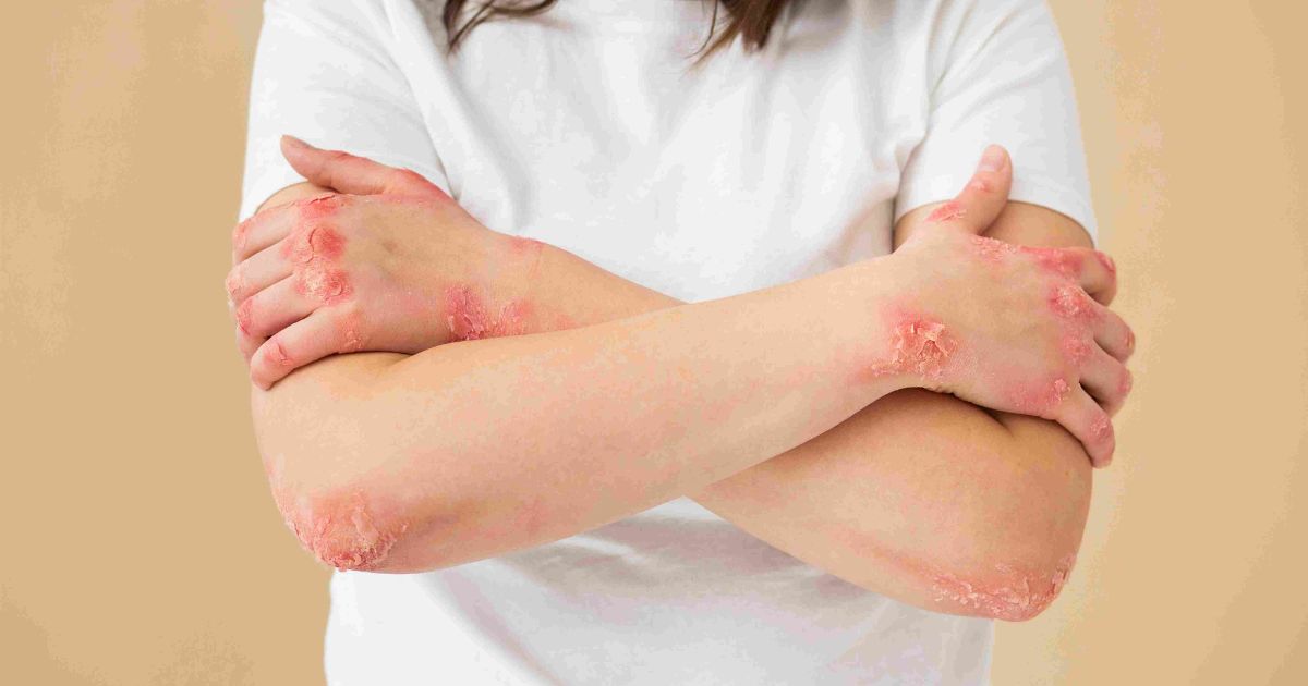 Drool Rash vs Eczema Explained: Causes, Symptoms, and Treatments