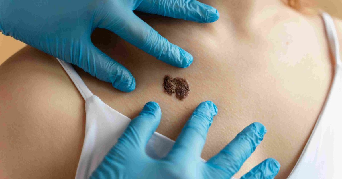 How Tretinoin Can Help You Get Rid of Flat Warts