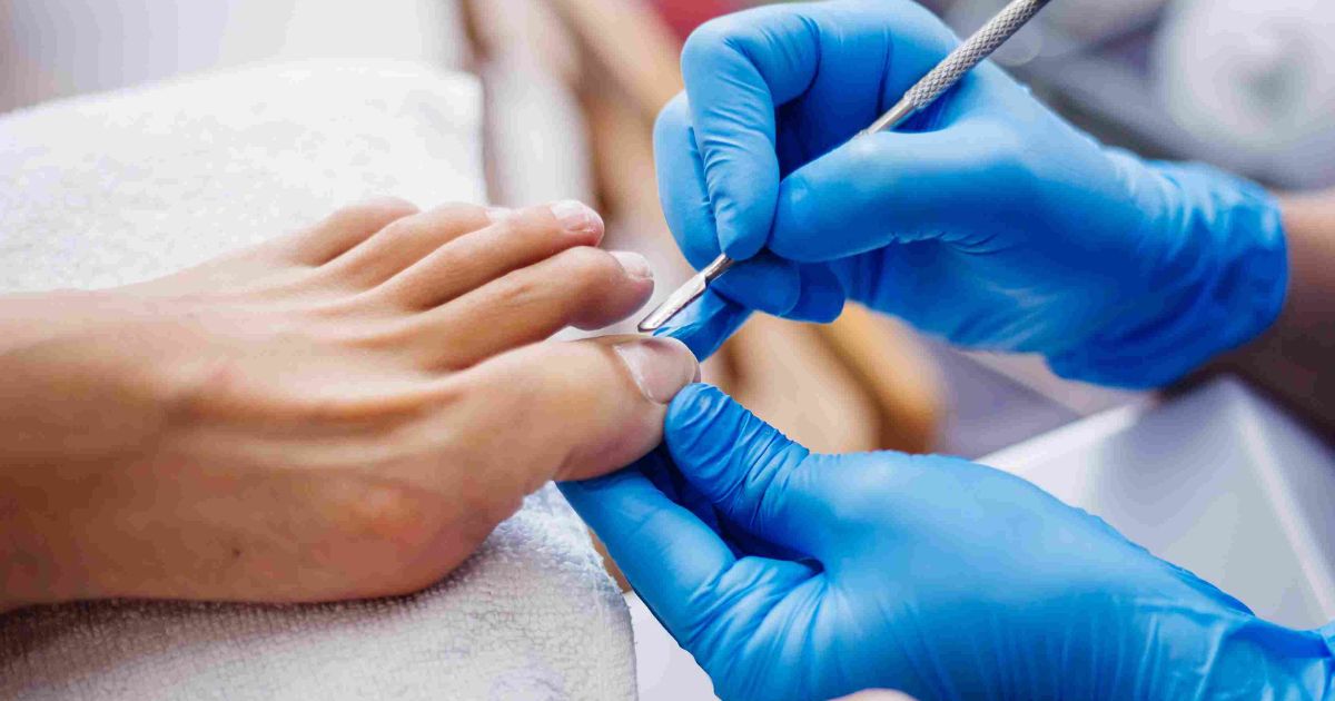 Plantar Warts Explained: Causes, Symptoms, and Best Treatments