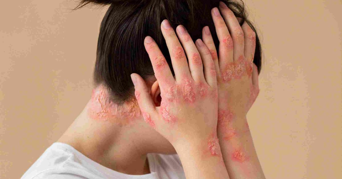 Spongiotic Dermatitis Explained: Causes, Symptoms, and Relief Tips