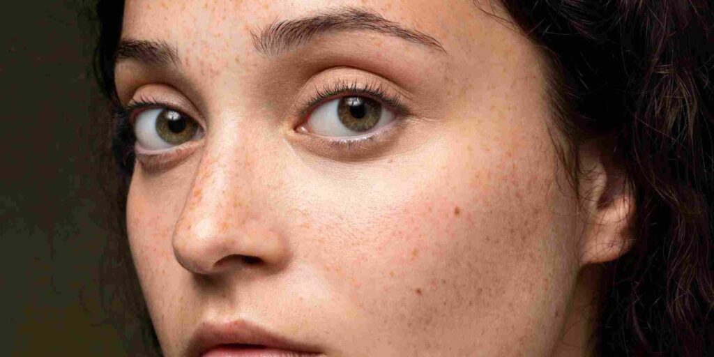 What Are White Sun Spots and How to Treat Them